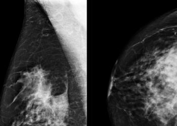 A e zbulon inteligjenca artificiale kancerin e gjirit më mirë se mjekët?