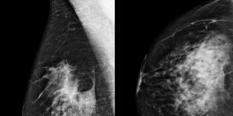 A e zbulon inteligjenca artificiale kancerin e gjirit më mirë se mjekët?
